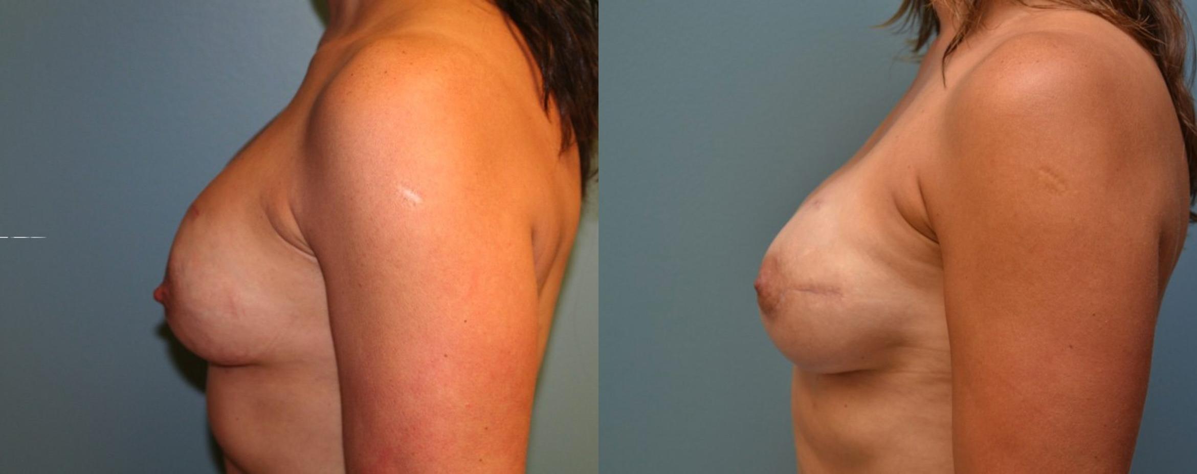 Before & After Breast Reconstruction Case 162 View #2 View in Albany & Latham, New York