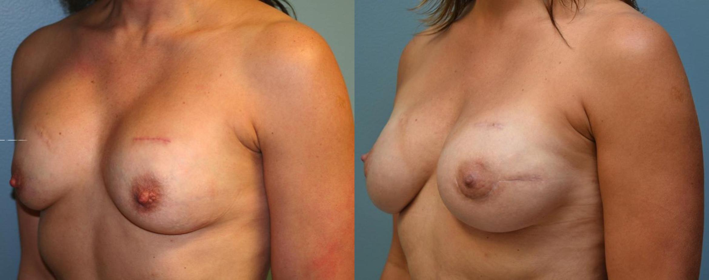 Before & After Breast Reconstruction Case 162 View #3 View in Albany & Latham, New York