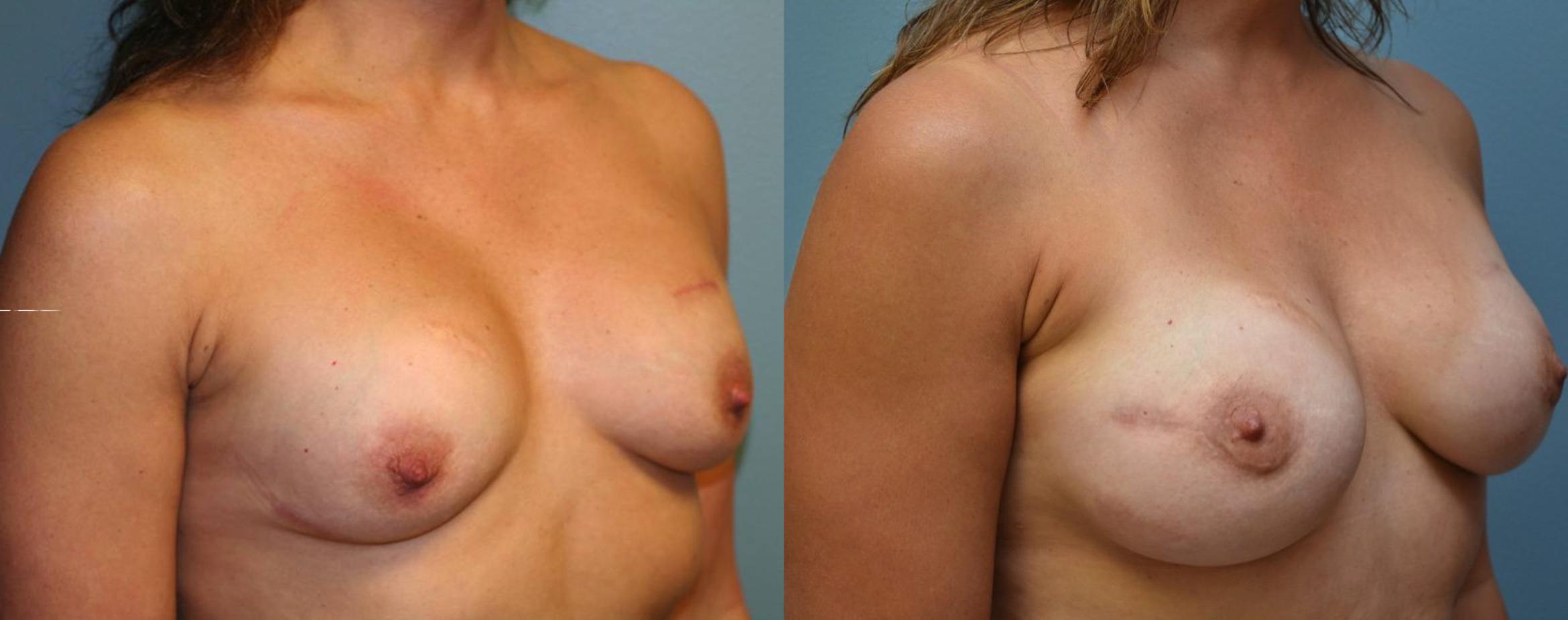 Before & After Breast Reconstruction Case 162 View #4 View in Albany & Latham, New York