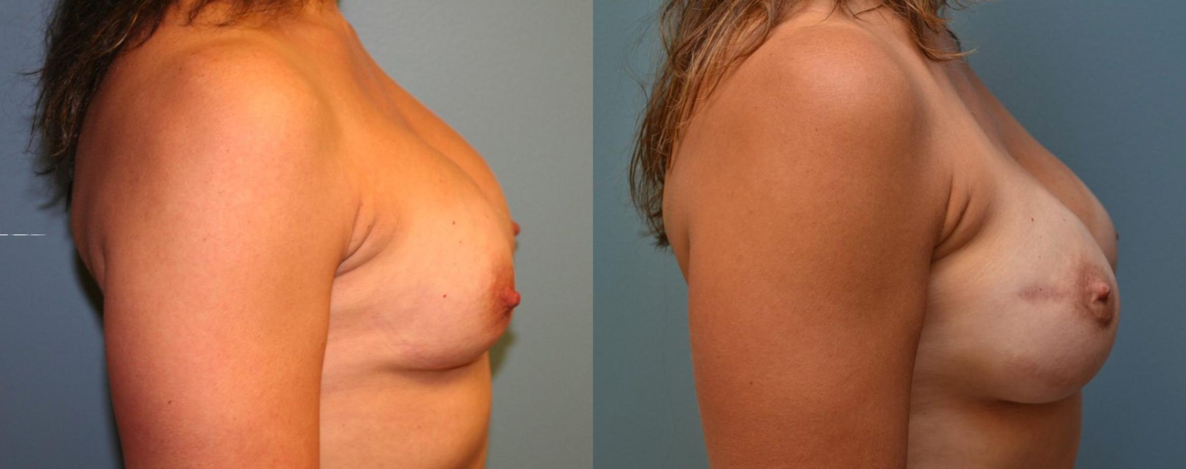 Before & After Breast Reconstruction Case 162 View #5 View in Albany & Latham, New York