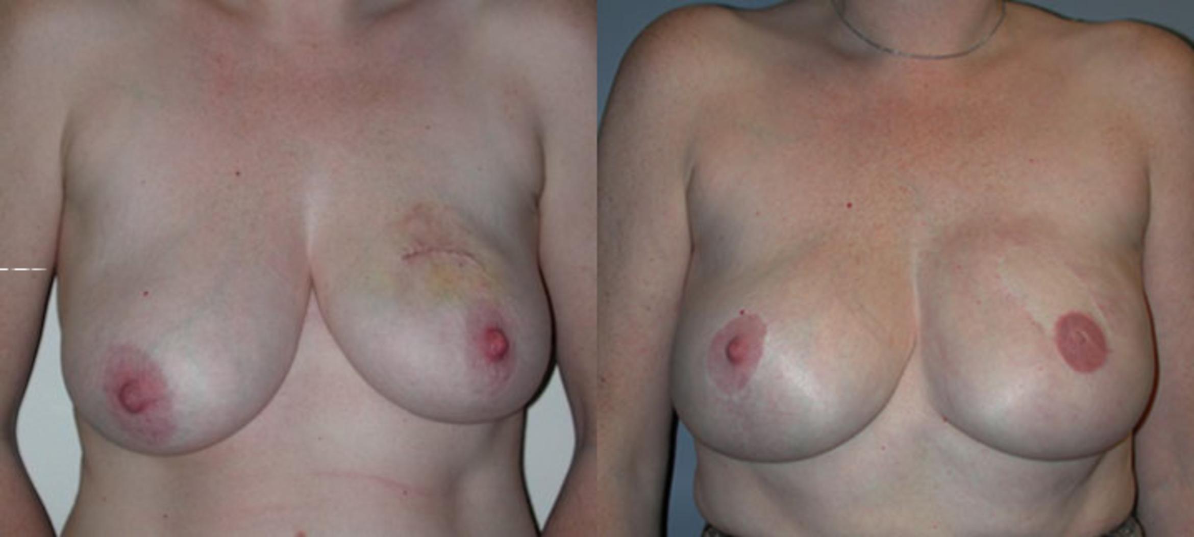 Before & After Breast Reconstruction Case 36 View #2 View in Albany & Latham, New York