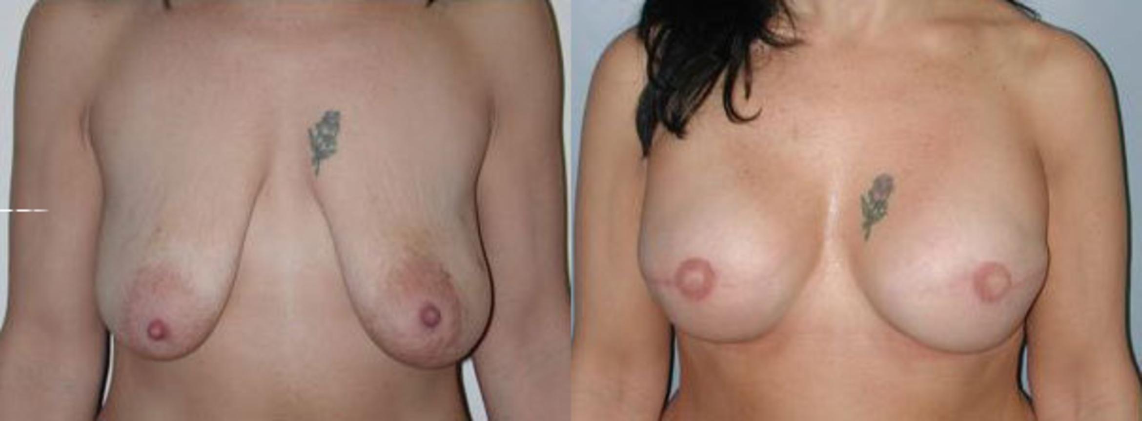 Before & After Breast Reconstruction Case 46 View #1 View in Albany & Latham, New York