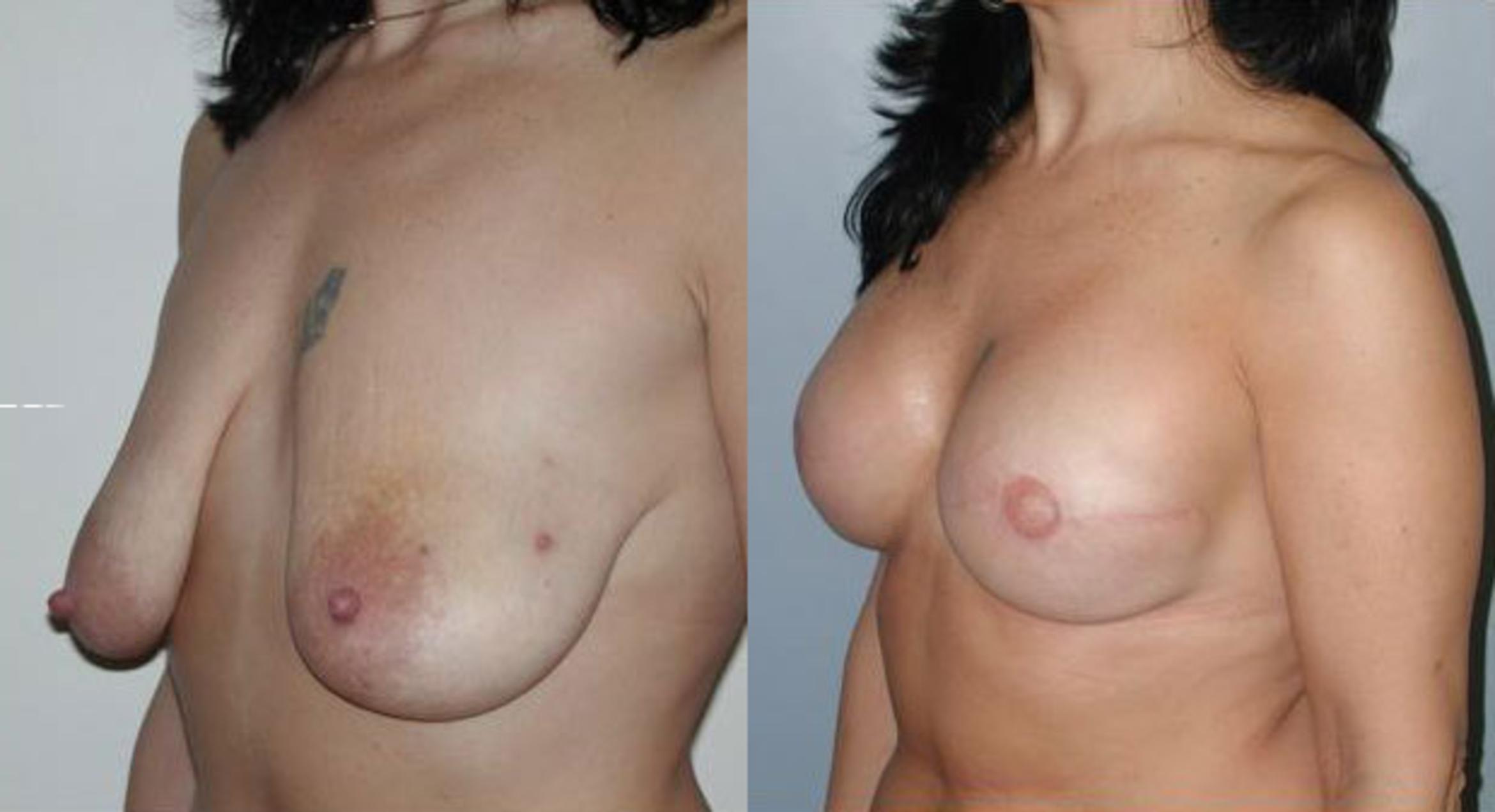 Before & After Breast Reconstruction Case 46 View #2 View in Albany & Latham, New York