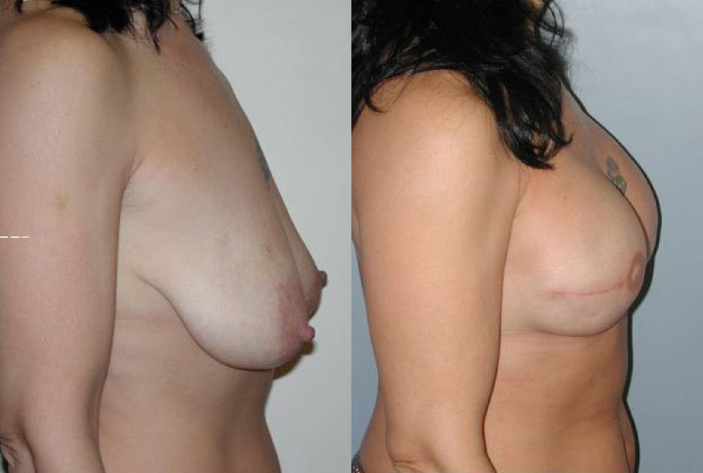 Before & After Breast Reconstruction Case 46 View #3 View in Albany & Latham, New York