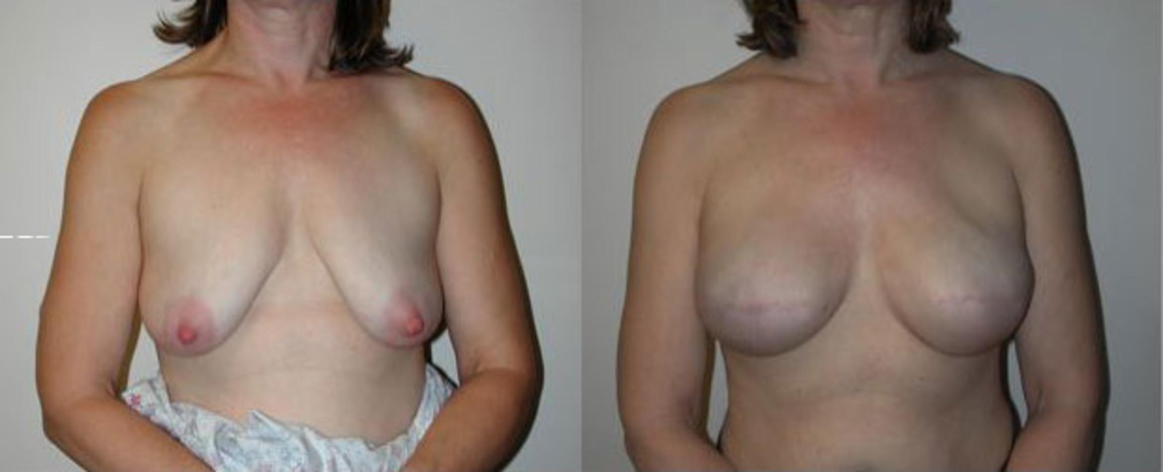 Before & After Breast Reconstruction Case 63 View #1 View in Albany & Latham, New York