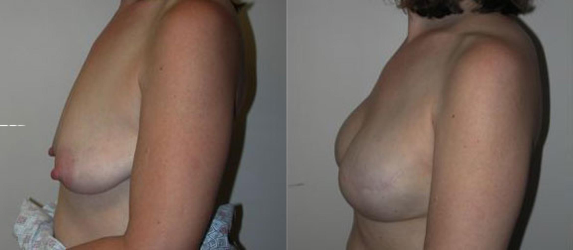 Before & After Breast Reconstruction Case 63 View #2 View in Albany & Latham, New York