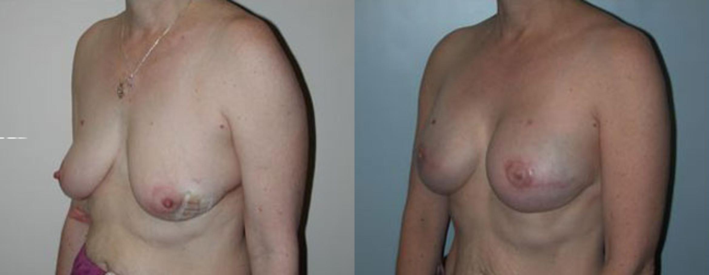 Before & After Breast Reconstruction Case 69 View #2 View in Albany & Latham, New York