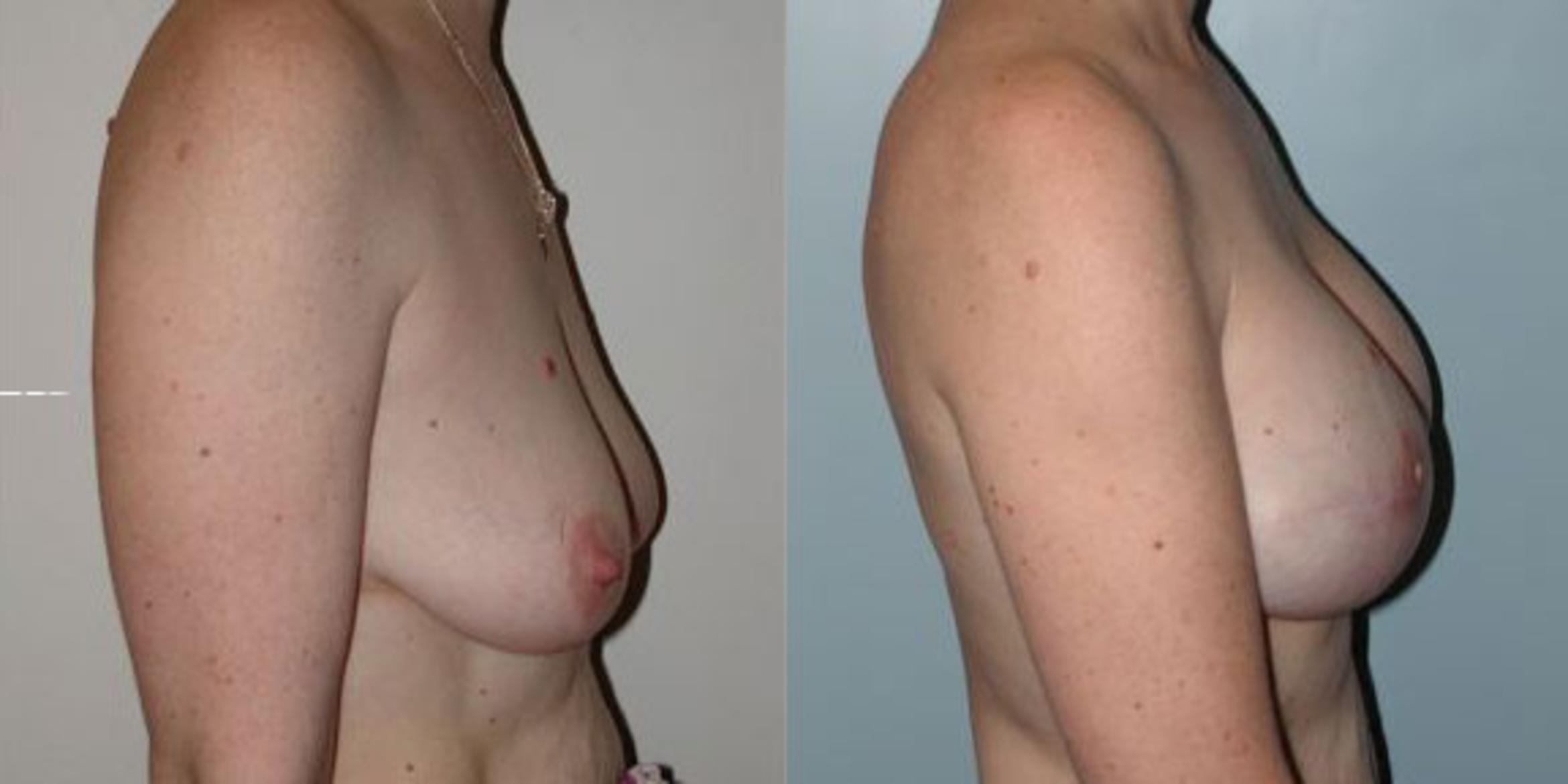 Before & After Breast Reconstruction Case 69 View #3 View in Albany & Latham, New York