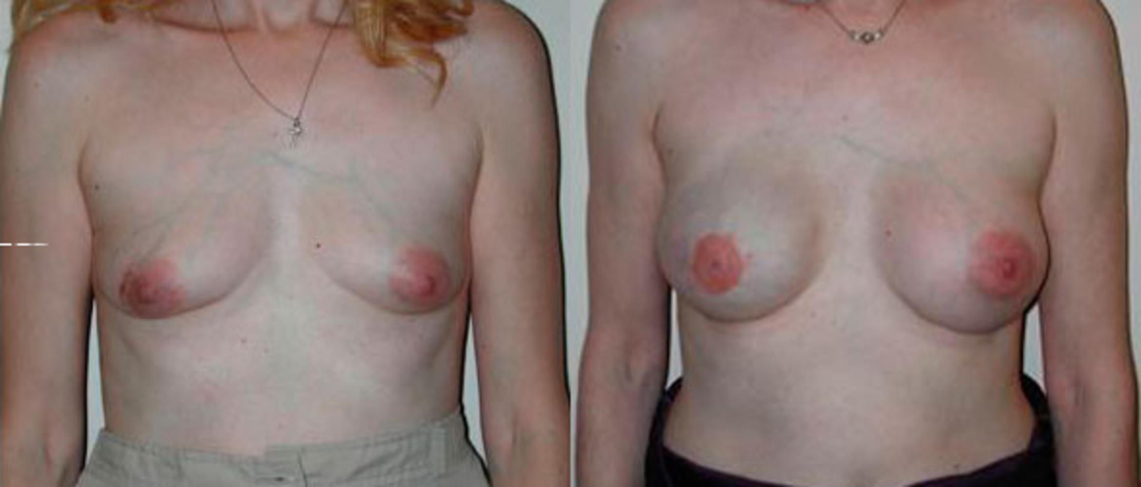 Before & After Breast Reconstruction Case 75 View #1 View in Albany & Latham, New York