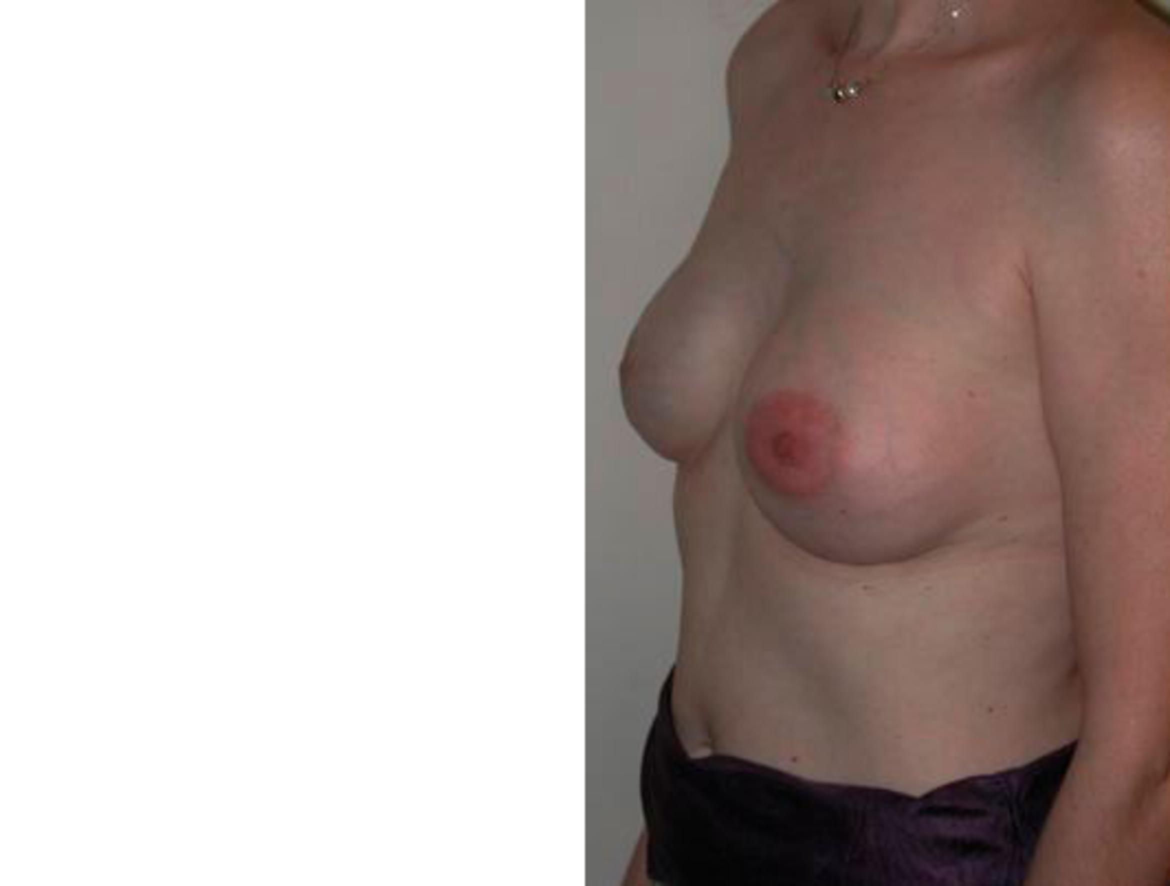 Before & After Breast Reconstruction Case 75 View #2 View in Albany & Latham, New York