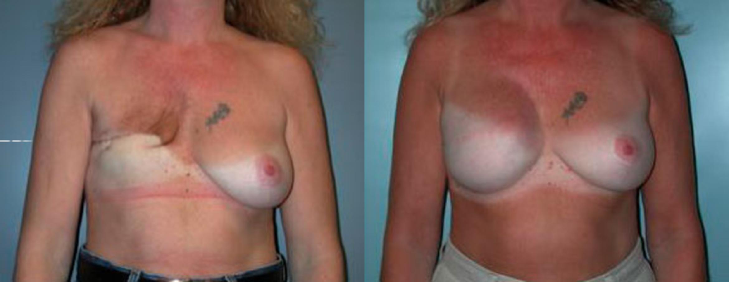 Before & After Breast Reconstruction Case 76 View #1 View in Albany & Latham, New York