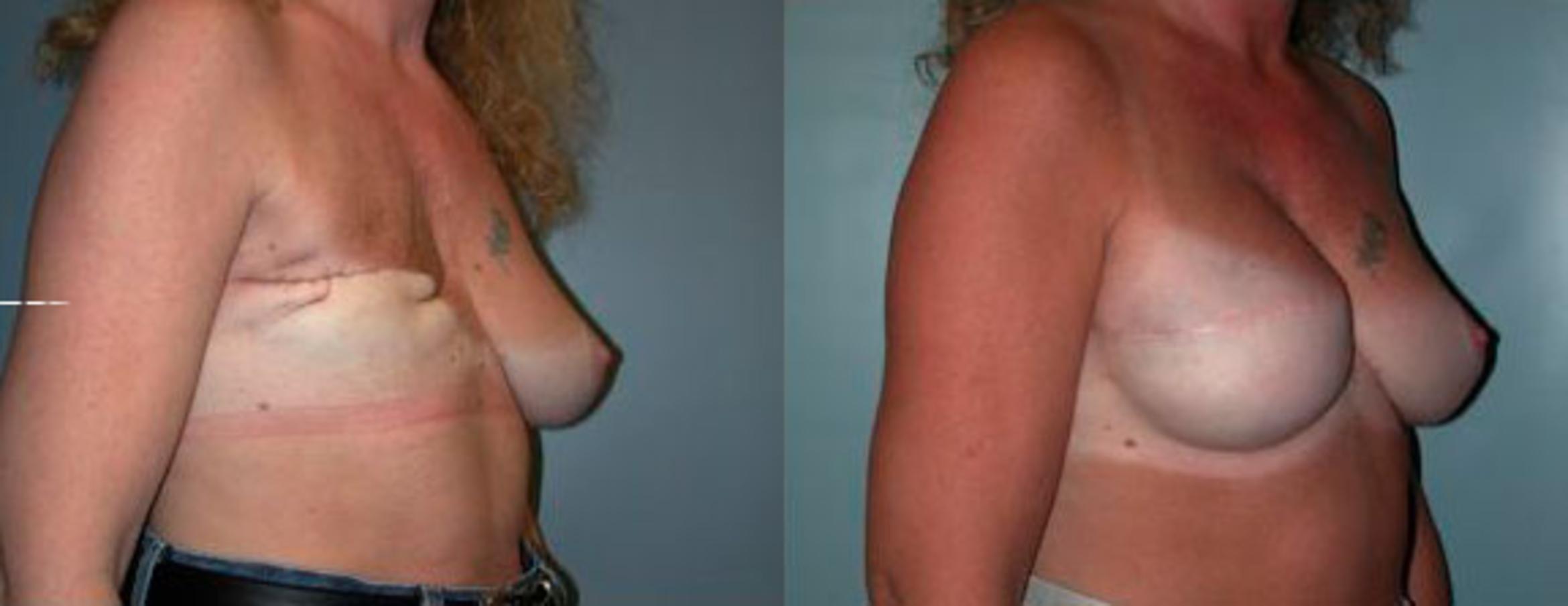 Before & After Breast Reconstruction Case 76 View #2 View in Albany & Latham, New York