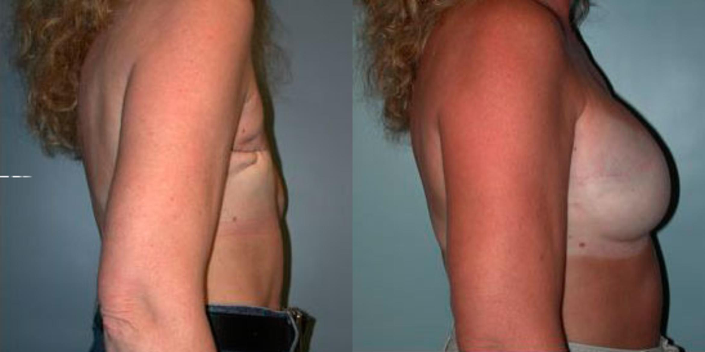 Before & After Breast Reconstruction Case 76 View #3 View in Albany & Latham, New York