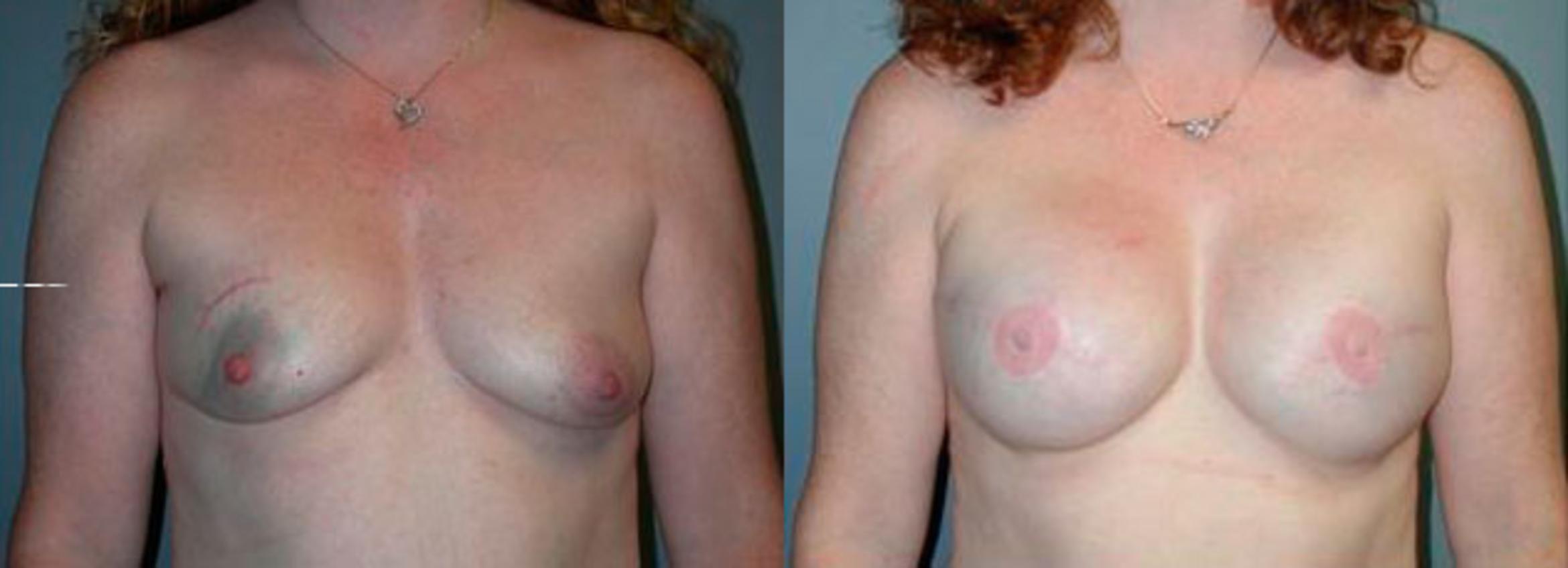 Before & After Breast Reconstruction Case 81 View #1 View in Albany & Latham, New York