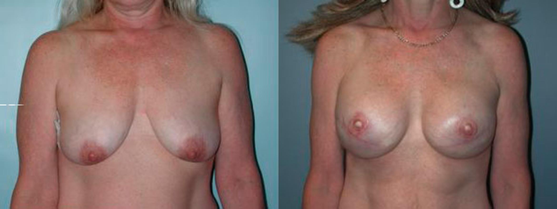 Before & After Breast Reconstruction Case 82 View #1 View in Albany & Latham, New York