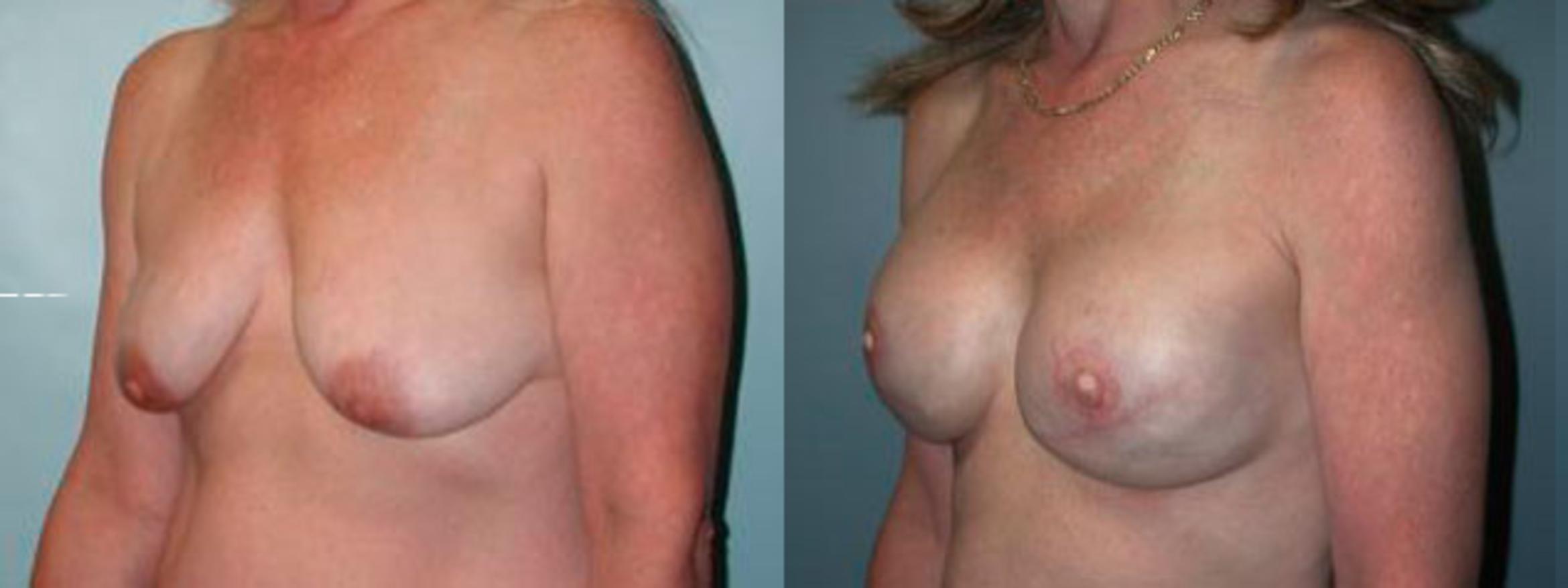 Before & After Breast Reconstruction Case 82 View #2 View in Albany & Latham, New York