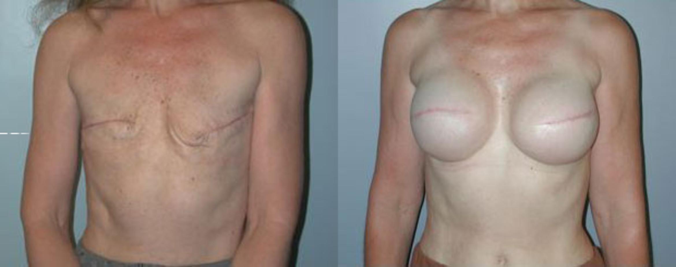Before & After Breast Reconstruction Case 85 View #1 View in Albany & Latham, New York