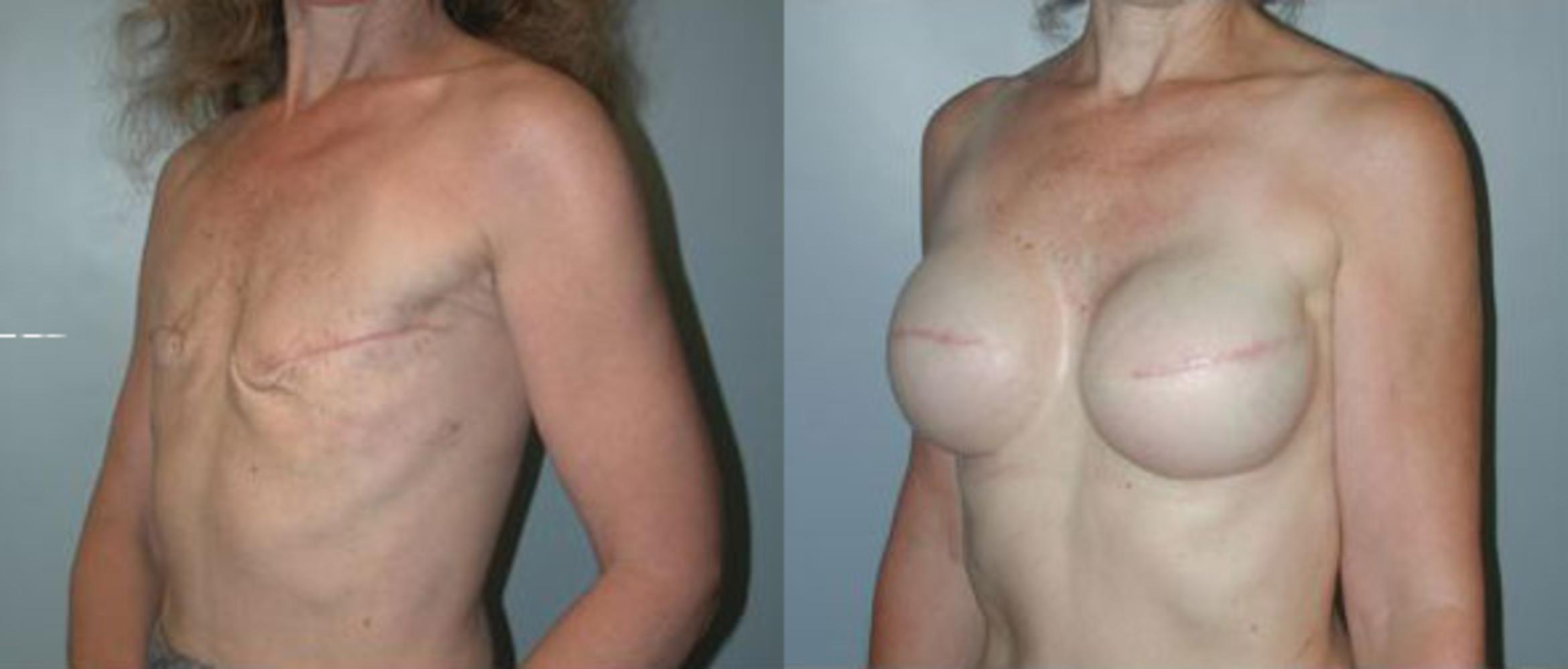 Before & After Breast Reconstruction Case 85 View #2 View in Albany & Latham, New York