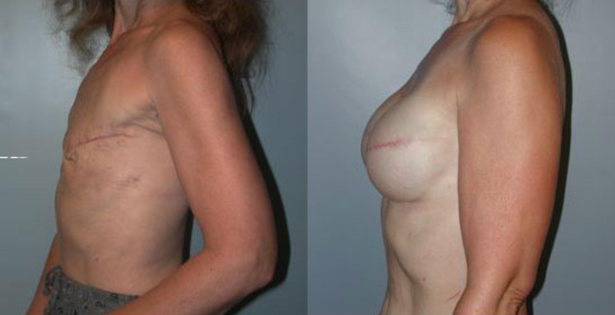 Before & After Breast Reconstruction Case 85 View #3 View in Albany & Latham, New York