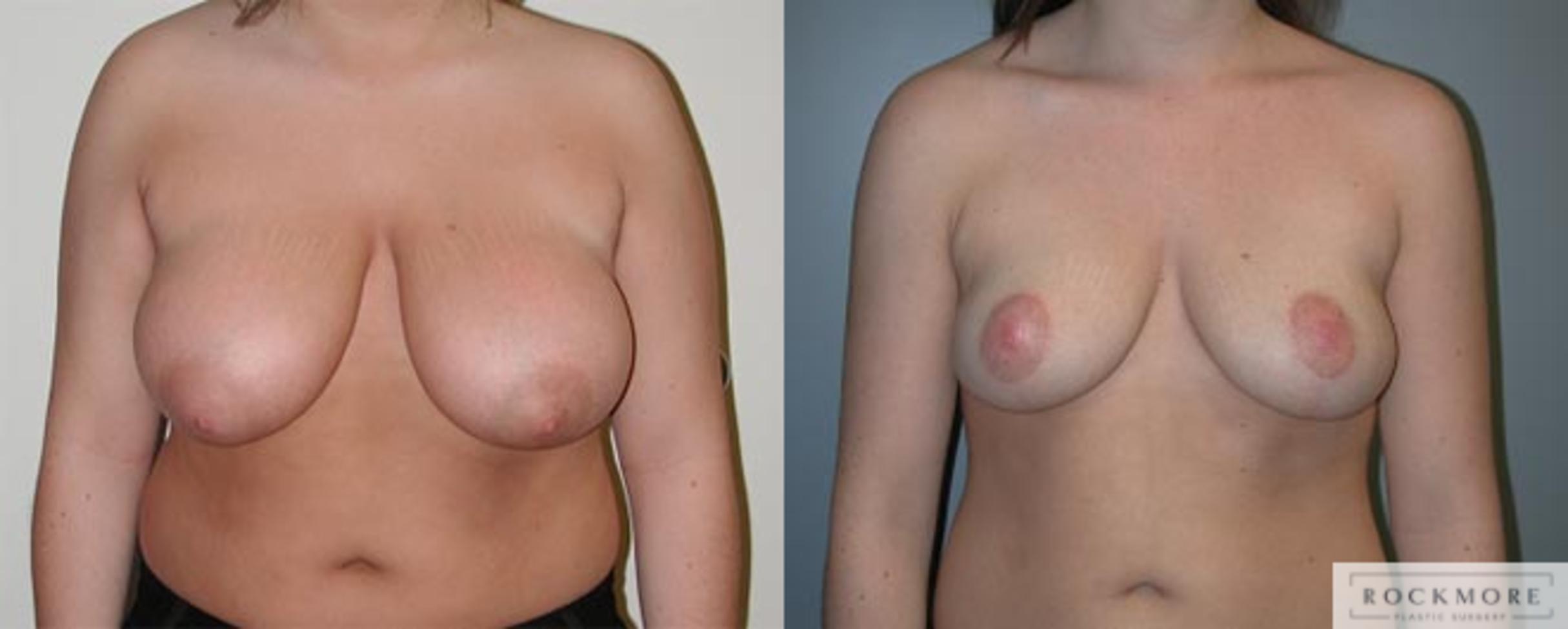 Before & After Breast Reduction Case 11 View #1 View in Albany & Latham, New York