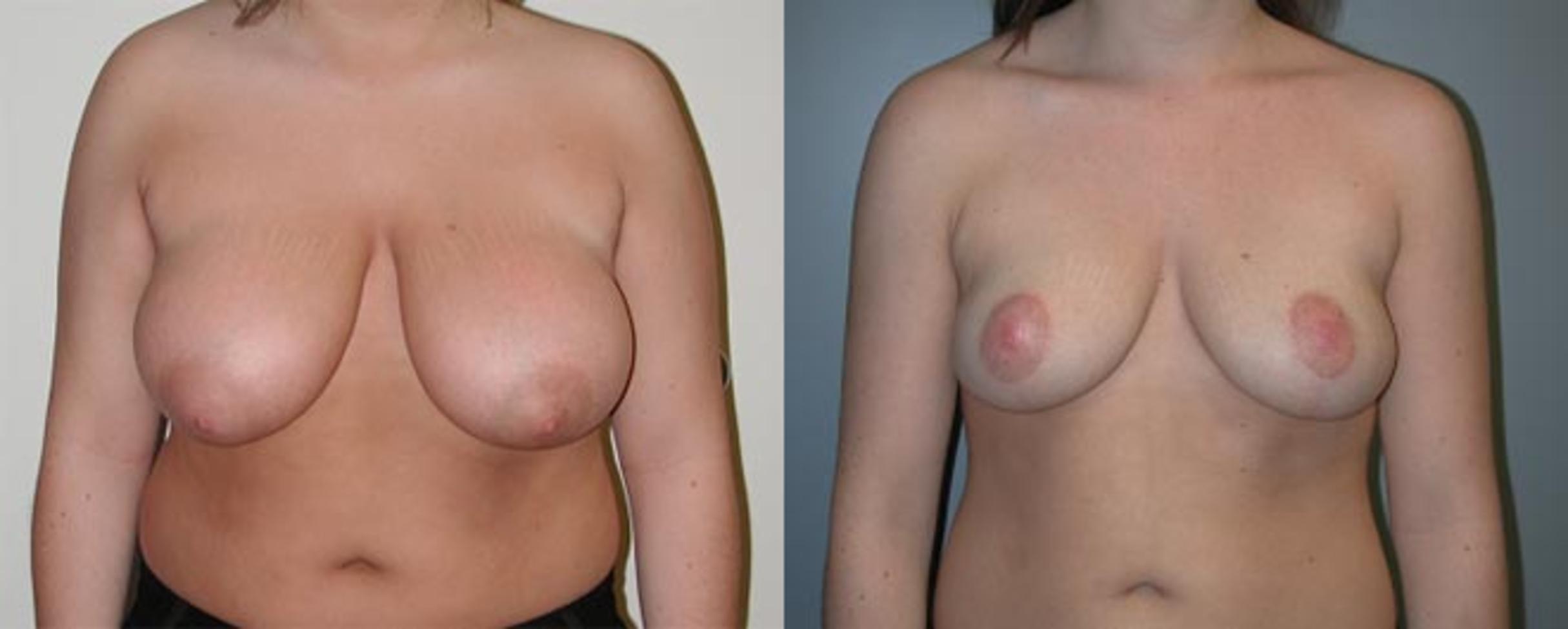 Before & After Breast Reduction Case 11 View #1 View in Albany & Latham, New York