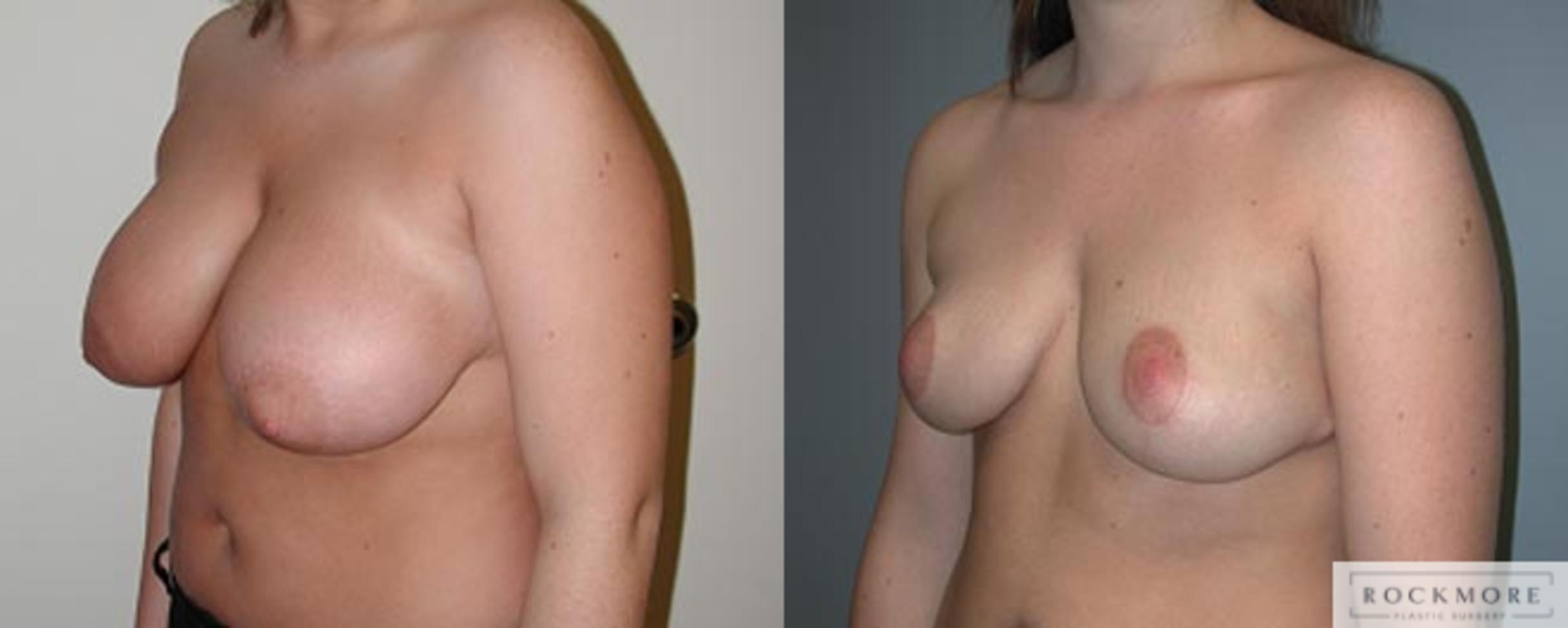 Before & After Breast Reduction Case 11 View #2 View in Albany & Latham, New York