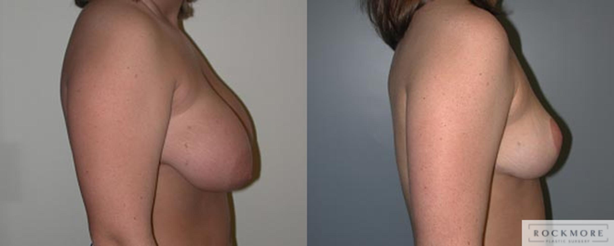 Before & After Breast Reduction Case 11 View #3 View in Albany & Latham, New York