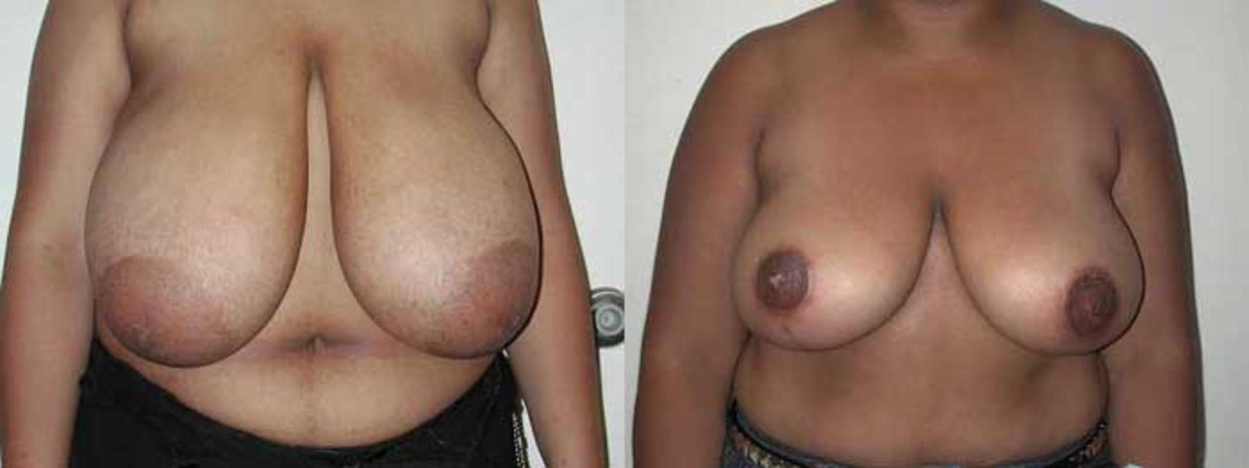 Before & After Breast Reduction Case 12 View #1 View in Albany, Latham & Saratoga, New York