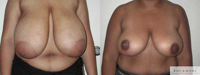 Before & After Breast Reduction Case 12 View #1 View in Albany & Latham, New York