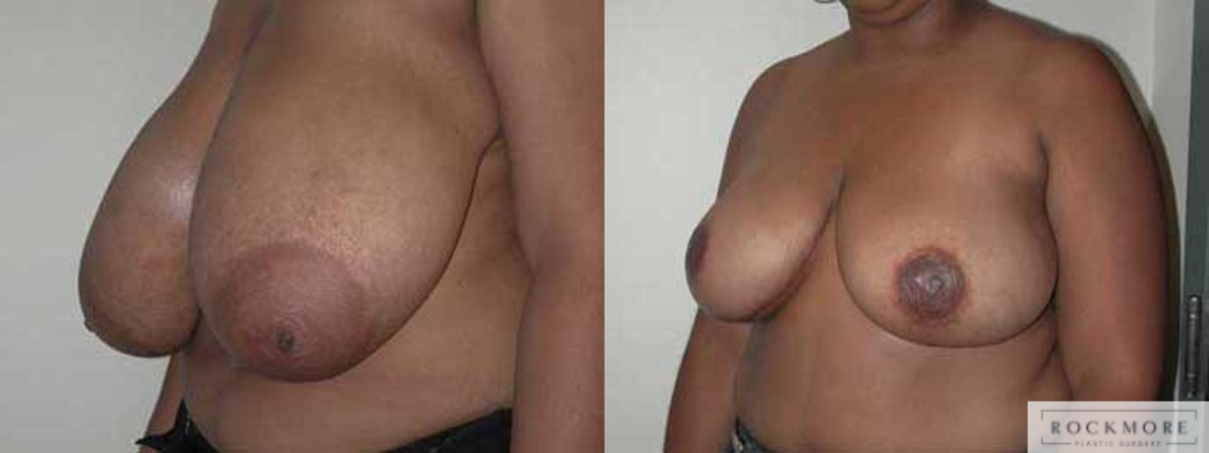 Before & After Breast Reduction Case 12 View #2 View in Albany & Latham, New York