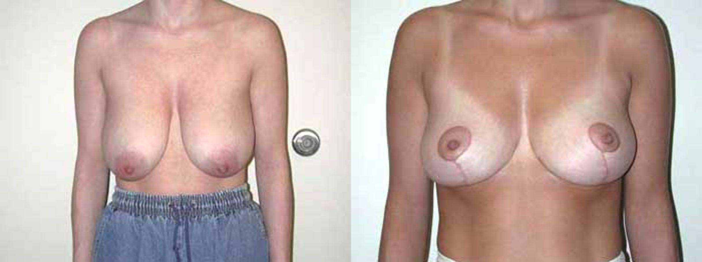 Before & After Breast Reduction Case 13 View #1 View in Albany & Latham, New York