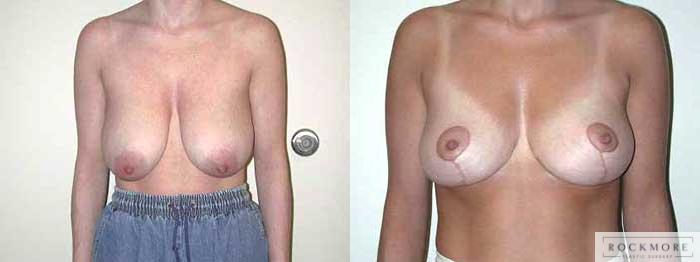 Before & After Breast Reduction Case 13 View #1 View in Albany & Latham, New York