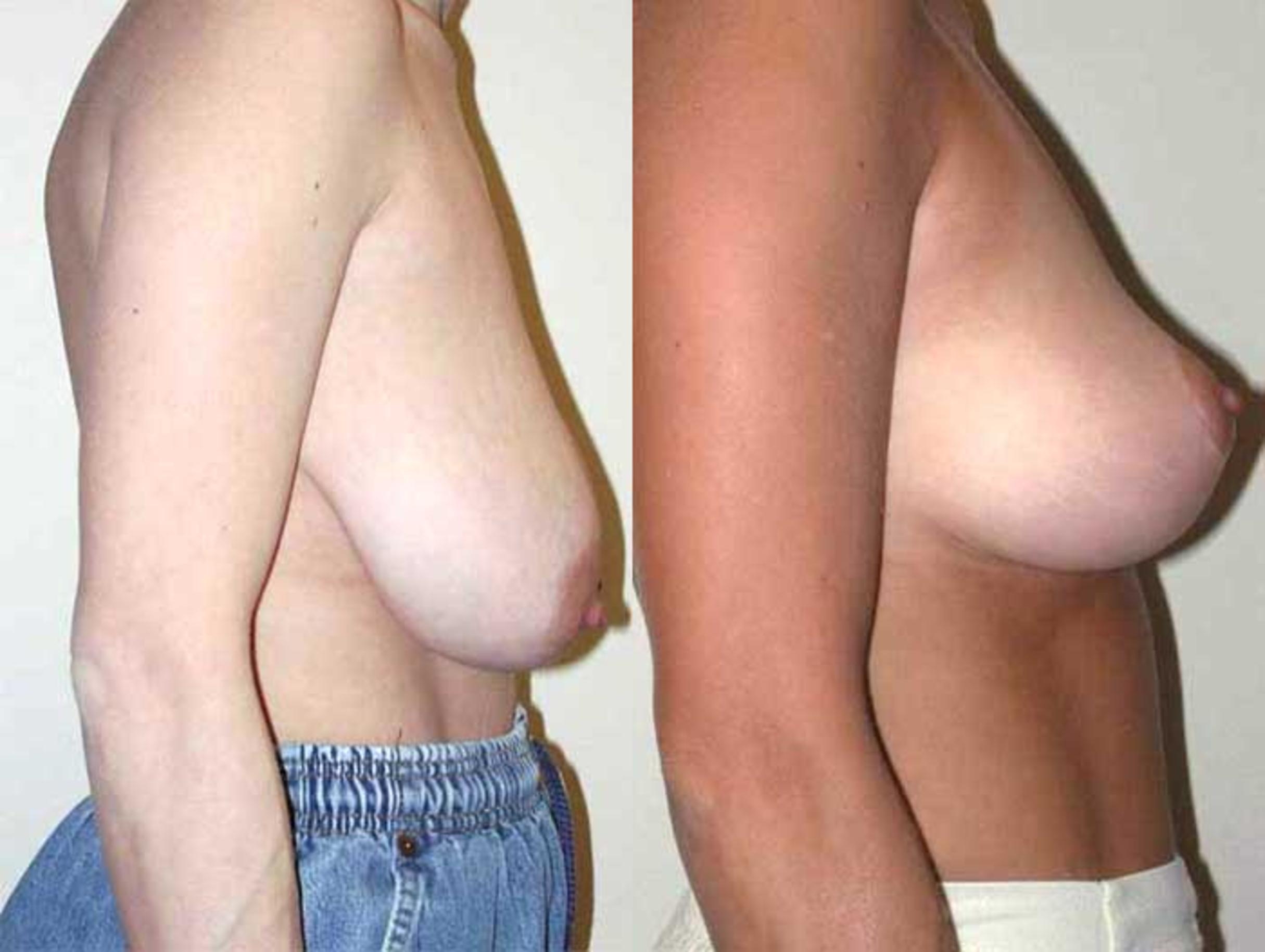 Before & After Breast Reduction Case 13 View #2 View in Albany & Latham, New York
