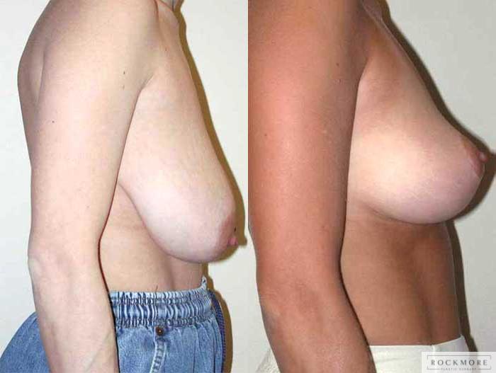 Before & After Breast Reduction Case 13 View #2 View in Albany & Latham, New York