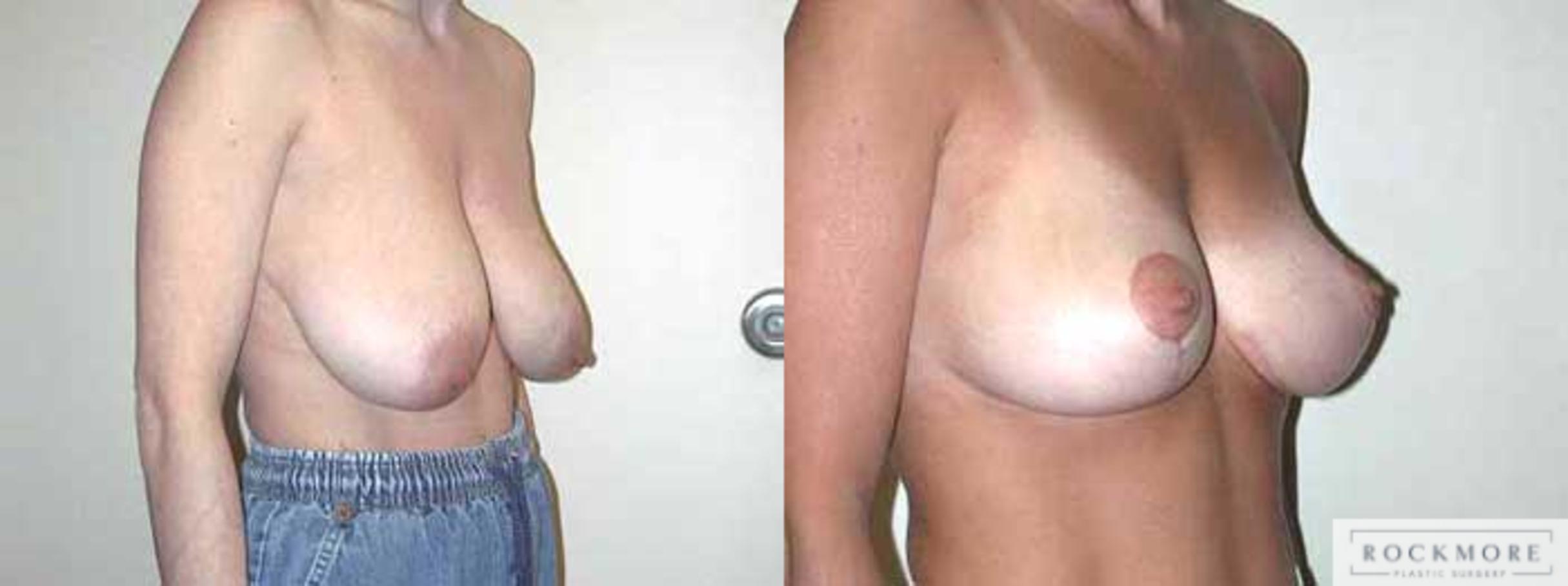 Before & After Breast Reduction Case 13 View #3 View in Albany & Latham, New York