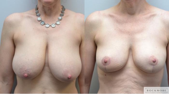 Before & After Breast Reduction Case 236 View #1 View in Albany & Latham, New York