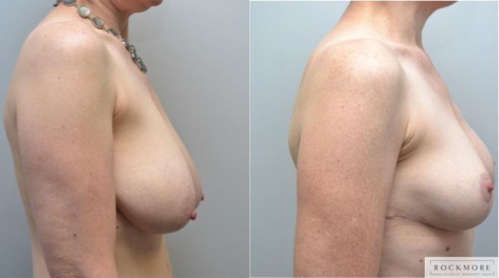Before & After Breast Reduction Case 236 View #2 View in Albany & Latham, New York