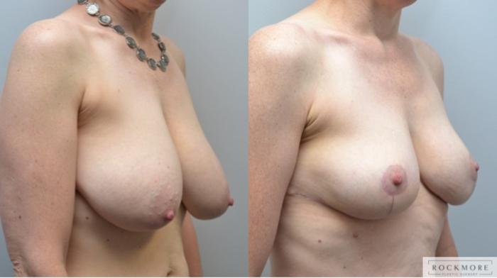 Before & After Breast Reduction Case 236 View #3 View in Albany & Latham, New York