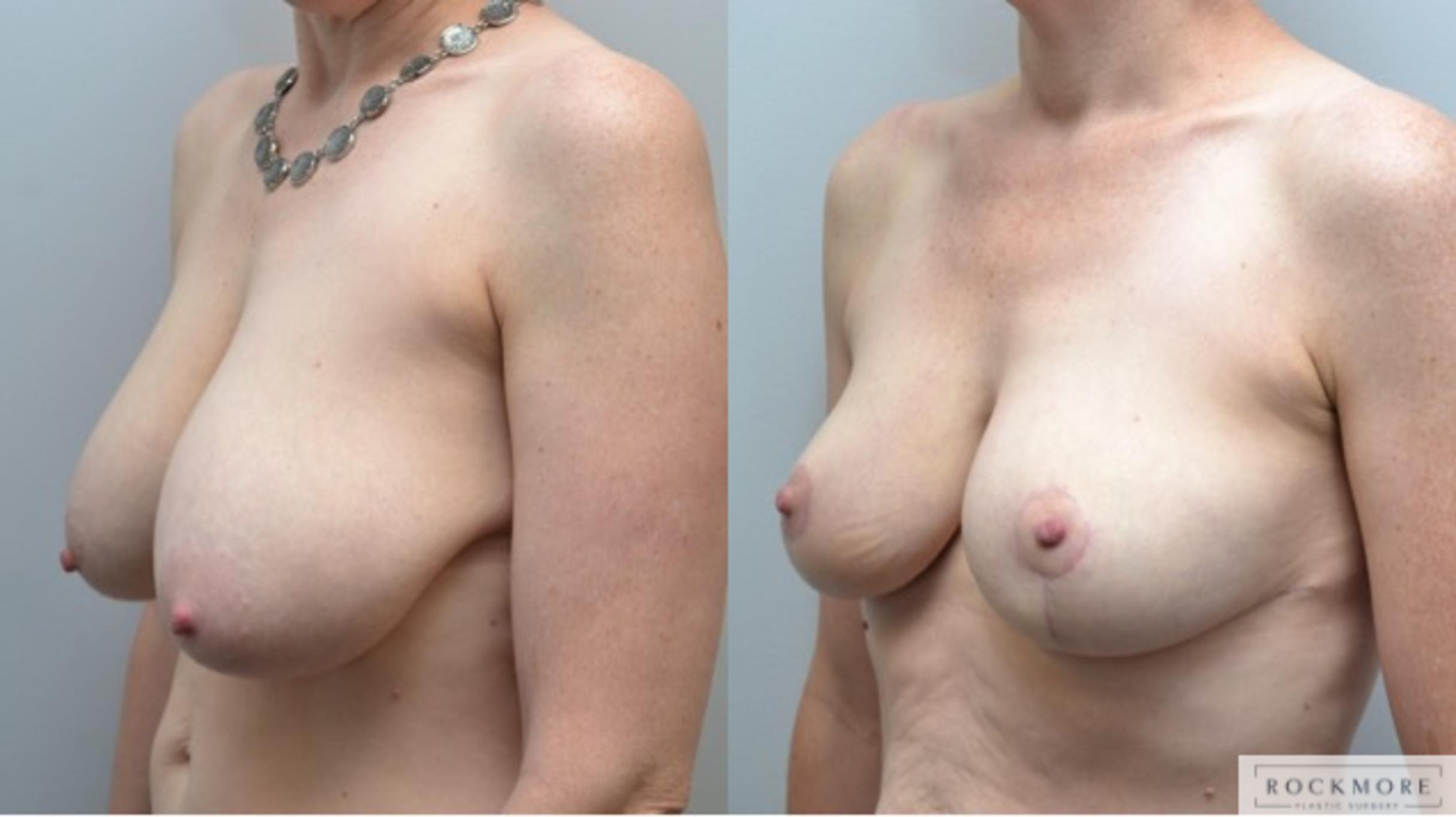 Before & After Breast Reduction Case 236 View #4 View in Albany & Latham, New York