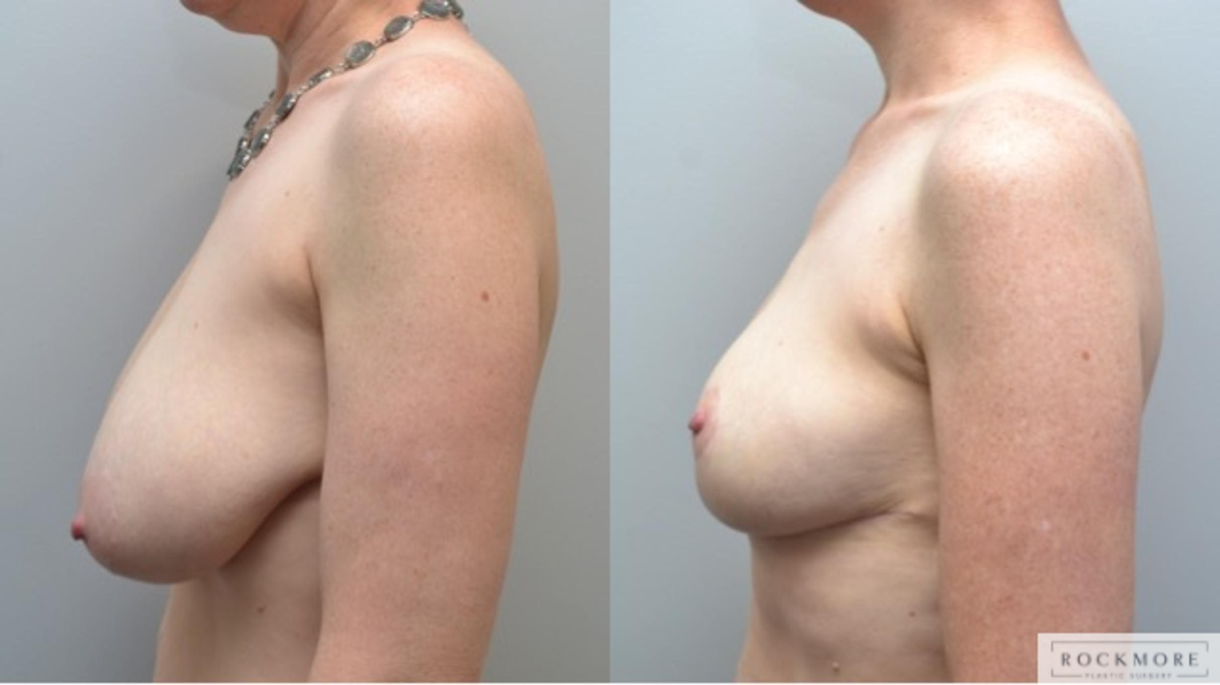 Before & After Breast Reduction Case 236 View #5 View in Albany & Latham, New York