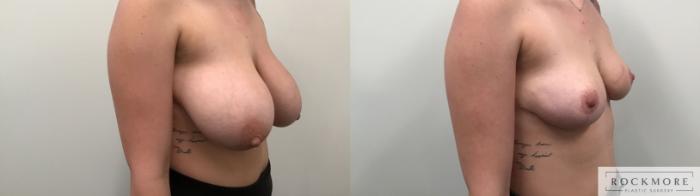 Before & After Breast Reduction Case 398 Right Oblique View in Albany & Latham, New York