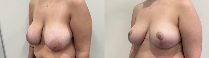 Before & After Breast Reduction Case 484 Left Oblique View in Albany, Latham & Saratoga, New York