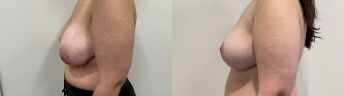 Before & After Breast Reduction Case 484 Left Side View in Albany, Latham & Saratoga, New York