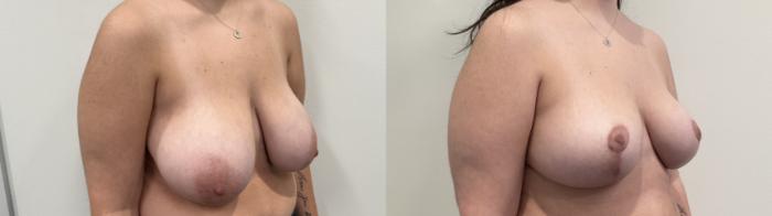 Before & After Breast Reduction Case 484 Right Oblique View in Albany, Latham & Saratoga, New York