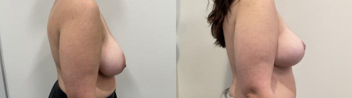 Before & After Breast Reduction Case 484 Right Side View in Albany, Latham & Saratoga, New York