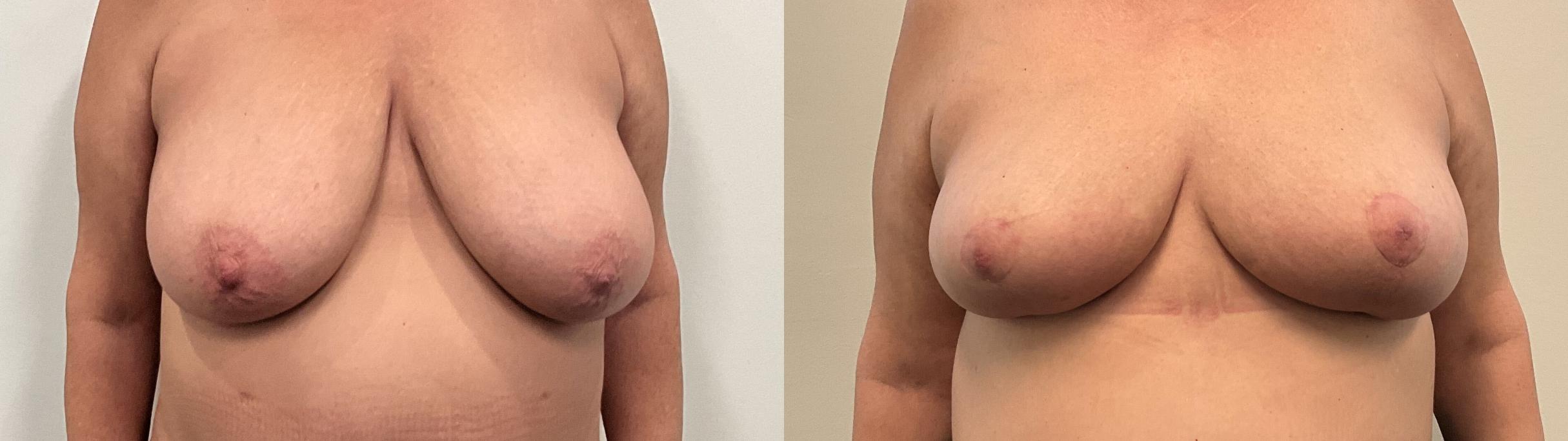 Before & After Breast Reduction Case 504 Front View in Albany, Latham & Saratoga, New York