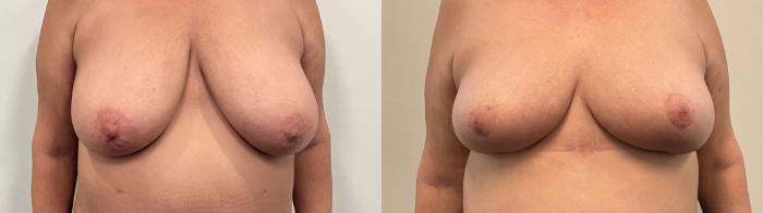 Before & After Breast Reduction Case 504 Front View in Albany, Latham & Saratoga, New York