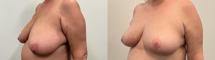 Before & After Breast Reduction Case 504 Left Oblique View in Albany, Latham & Saratoga, New York