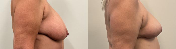 Before & After Breast Reduction Case 504 Right Side View in Albany, Latham & Saratoga, New York