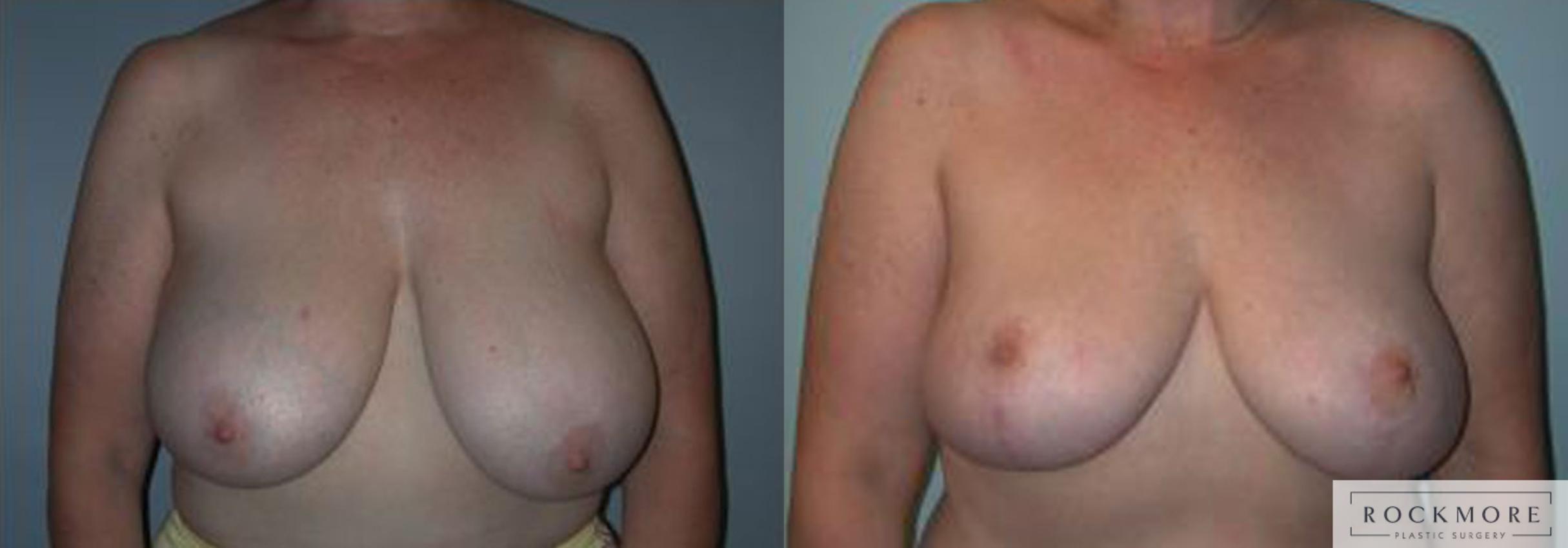 Before & After Breast Reduction Case 62 View #1 View in Albany & Latham, New York